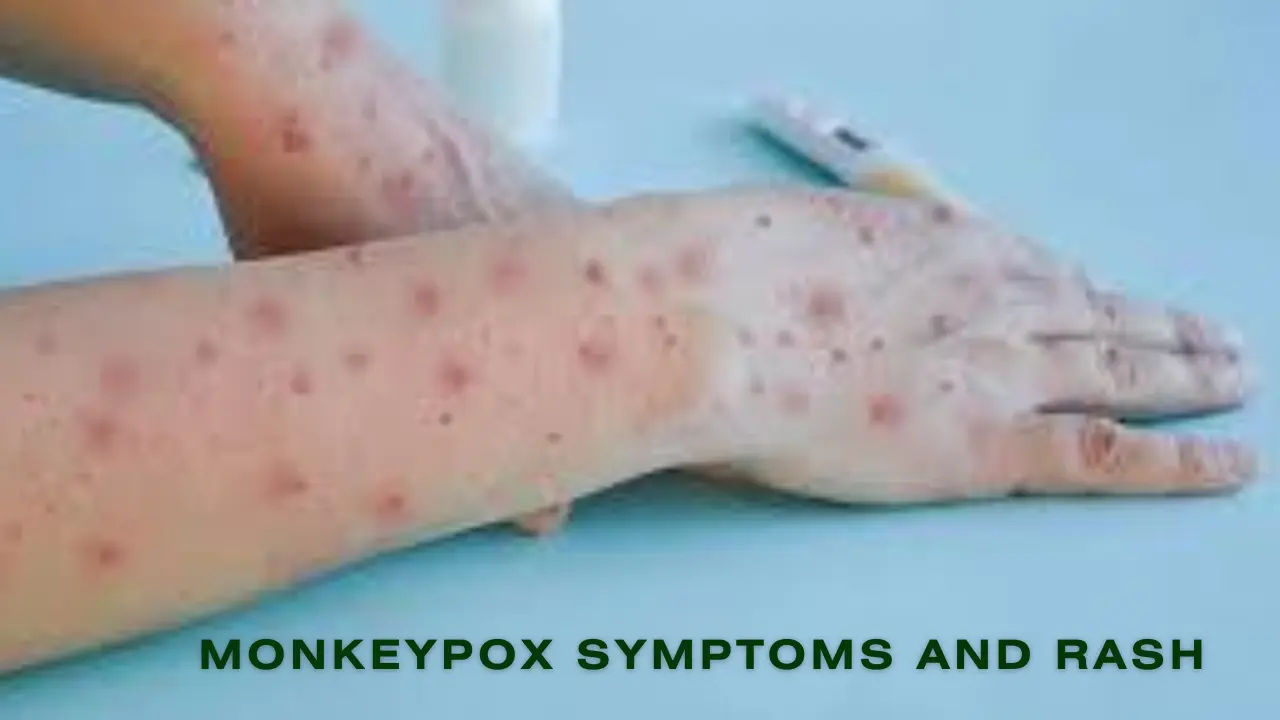 MonkeyPox Symptems