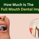 How Much Is The Cost Of Full Mouth Dental Implants?