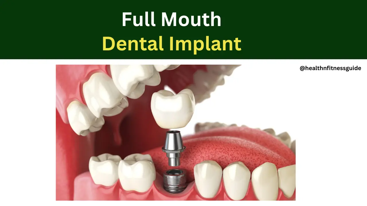 Full Mouth Dental Implant cost