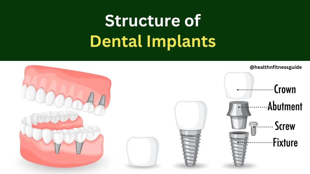 structure of dental implants